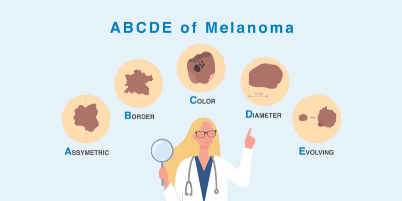 ABCDE of Melanoma illustration.