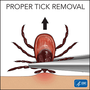 Proper tick removal