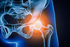 Orthopedic graphic of hip