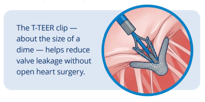 Illustration of T-TEER clip
