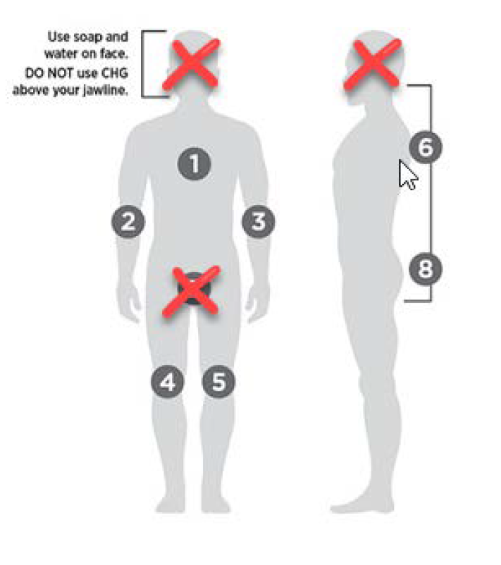 Diagram showing pre‑surgery shower instructions. Soap and water should be used on the face, and CHG should not be used above the jawline. Red X symbols indicate areas where CHG should not be used, including the head and genital area. Numbered areas identify body regions for washing, such as the chest, arms, legs, and back.