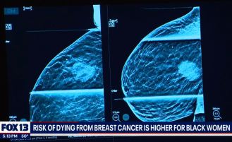 Overlake Cancer Center’s Eileen Consorti, MD, MS, Stephen Lemon, MD, and Terren Rodriguez shared their expertise on FOX 13, discussing the health disparities among Black women, who face a much higher risk of mortality from breast cancer and an increased risk of developing a more aggressive form of breast cancer.